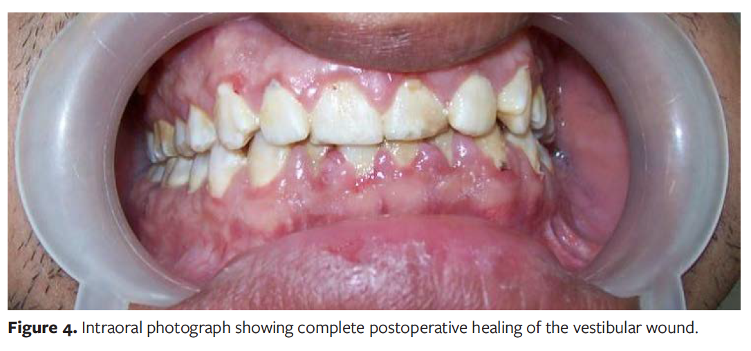 Intraoral Wound Dehiscence After Open Reduction Internal Fixation of